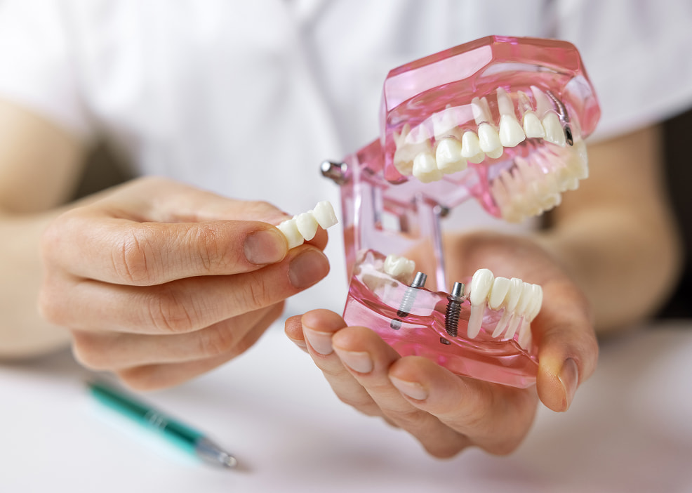 Dental Bridges