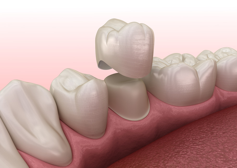 Dental Crowns