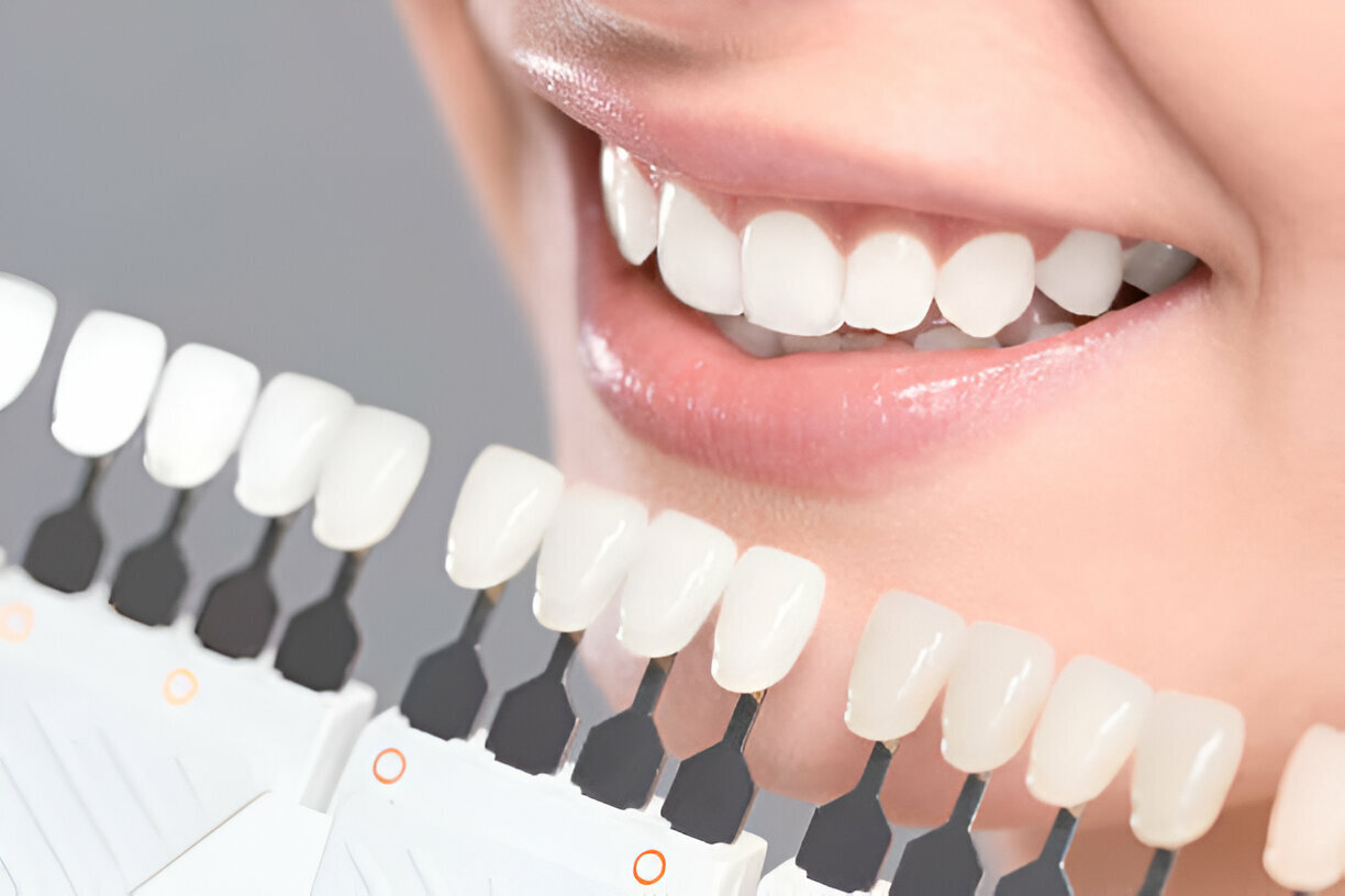 Why Raleigh Patients Choose Triangle Dentistry for Porcelain Veneers_FI
